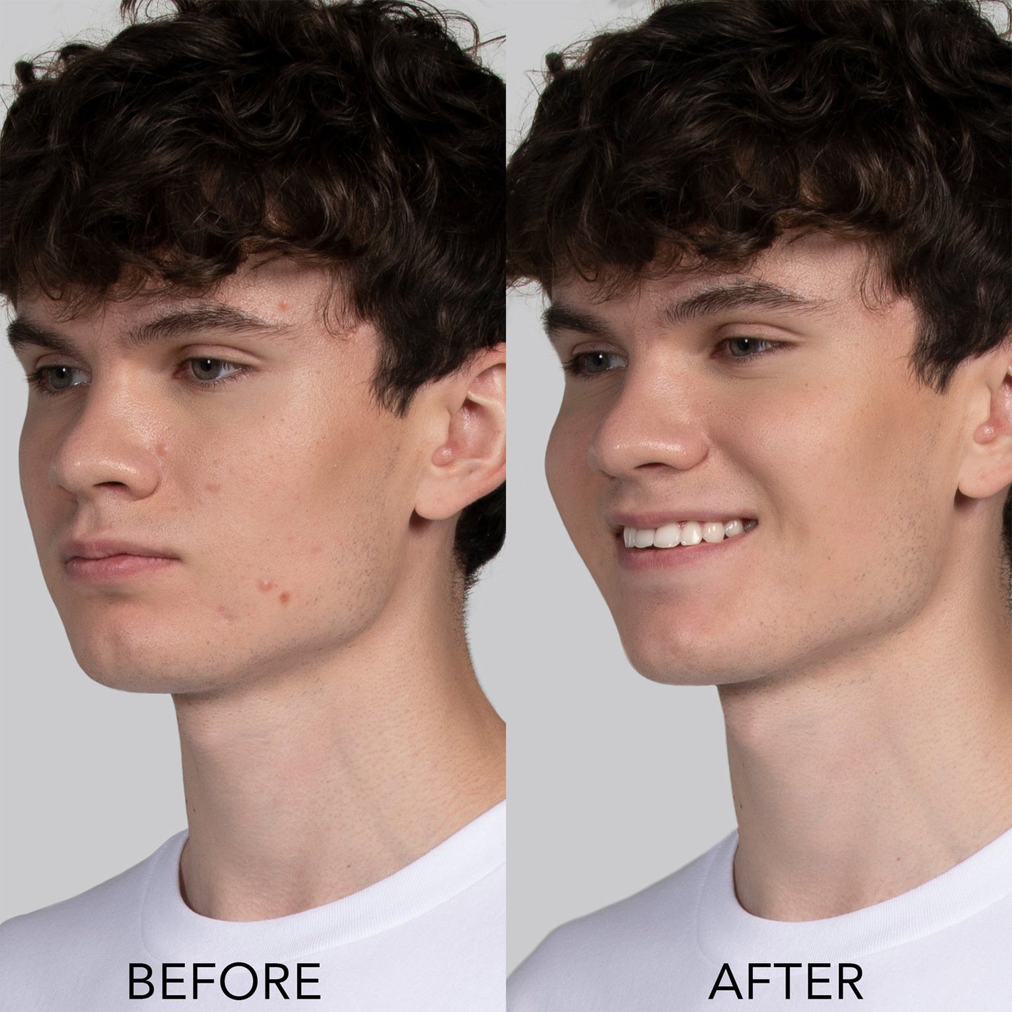 ESPADA™ 2 LED Therapy Acne Treatment Device ESPADA™ 2 (1259143_EA)