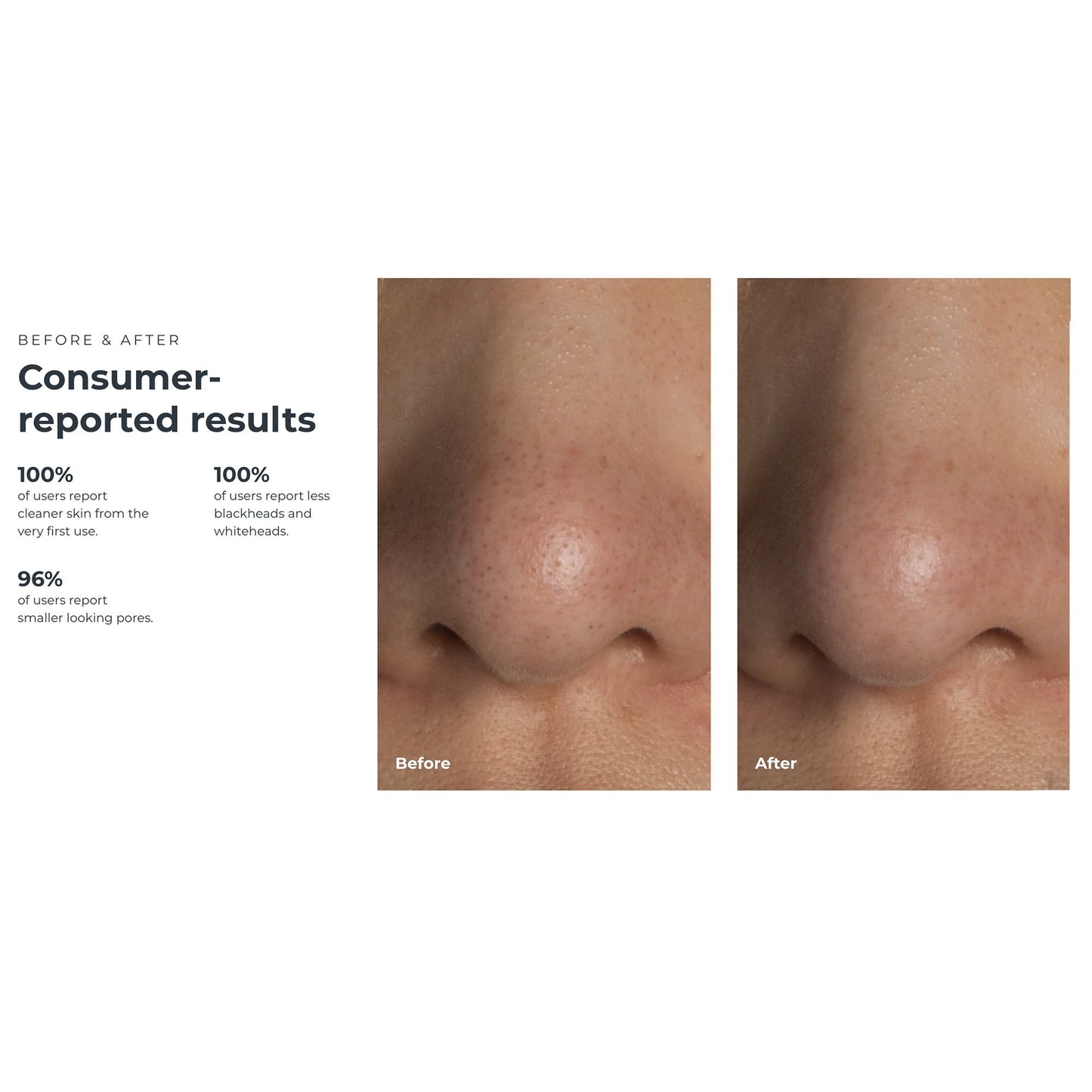 KIWI™ Blackhead Remover Pore Vacuum KIWI™ (1259139_EA)