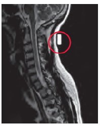 MRI Spee-D-Mark™ Radiology Skin Marker MRI Spee-D-Mark™ (888152_BX)