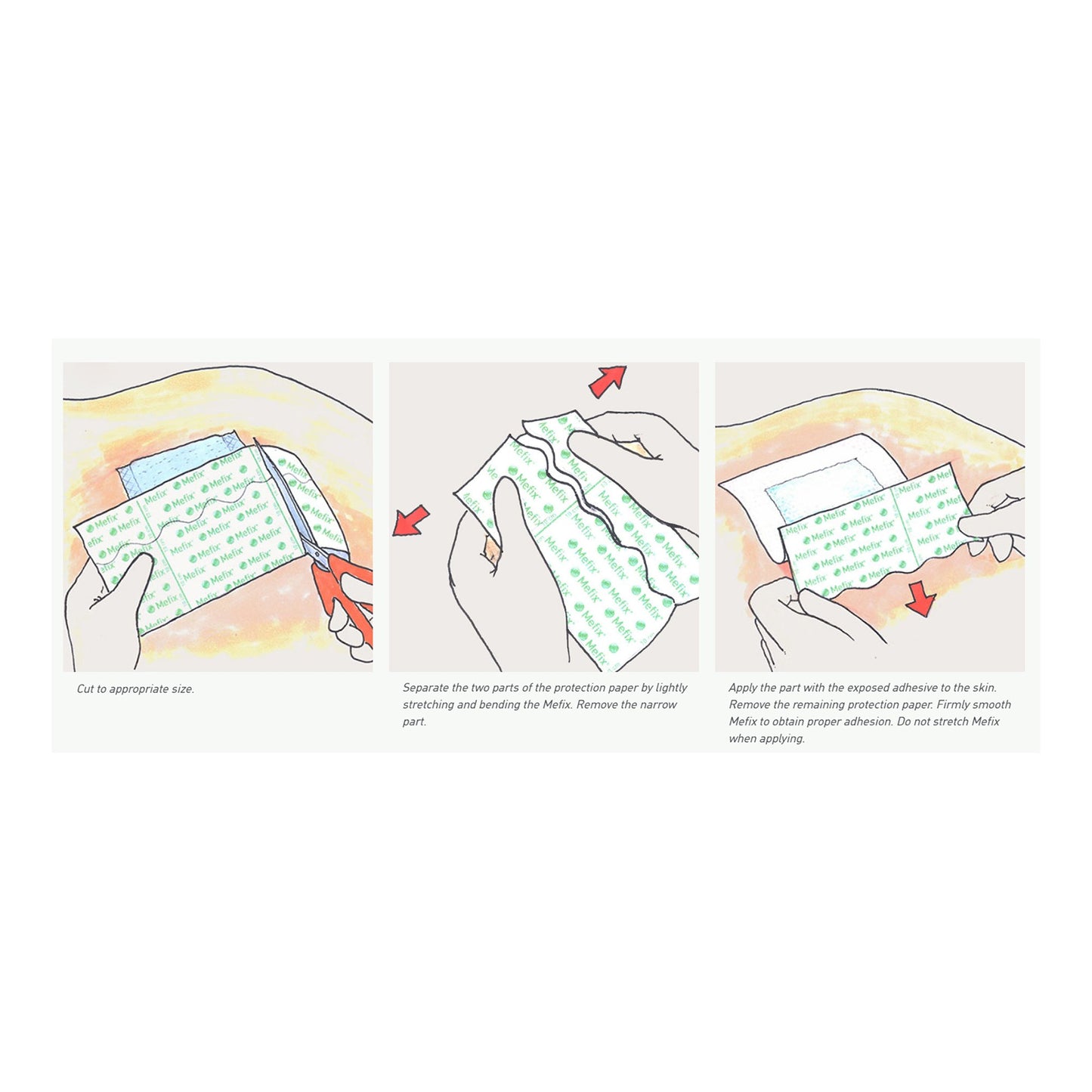 Mefix® Perforated Dressing Retention Tape with Liner White 4 Inch X 11 Yard Nonwoven Spunlace Polyester NonSterile (684056_CS)