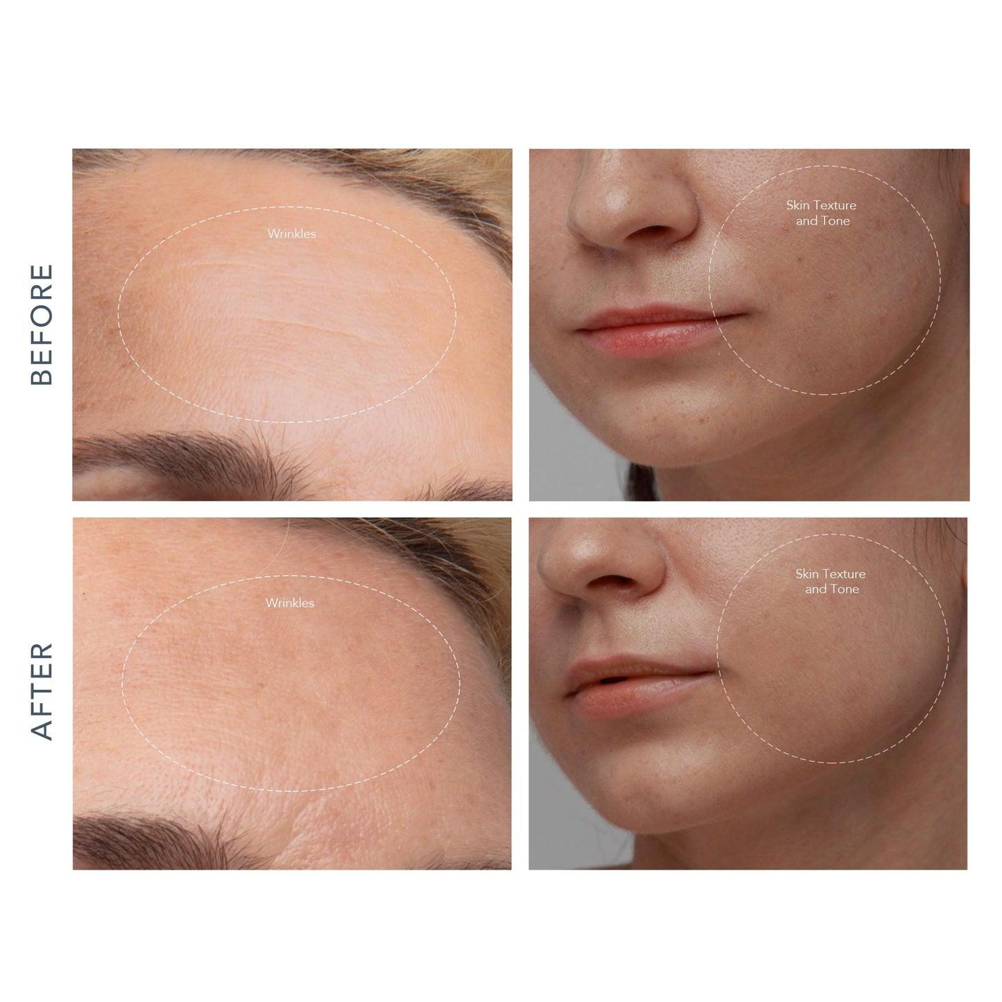 KIWI™ derma Diamond Microdermabrasion Pore Vacuum KIWI™ derma (1244547_EA)