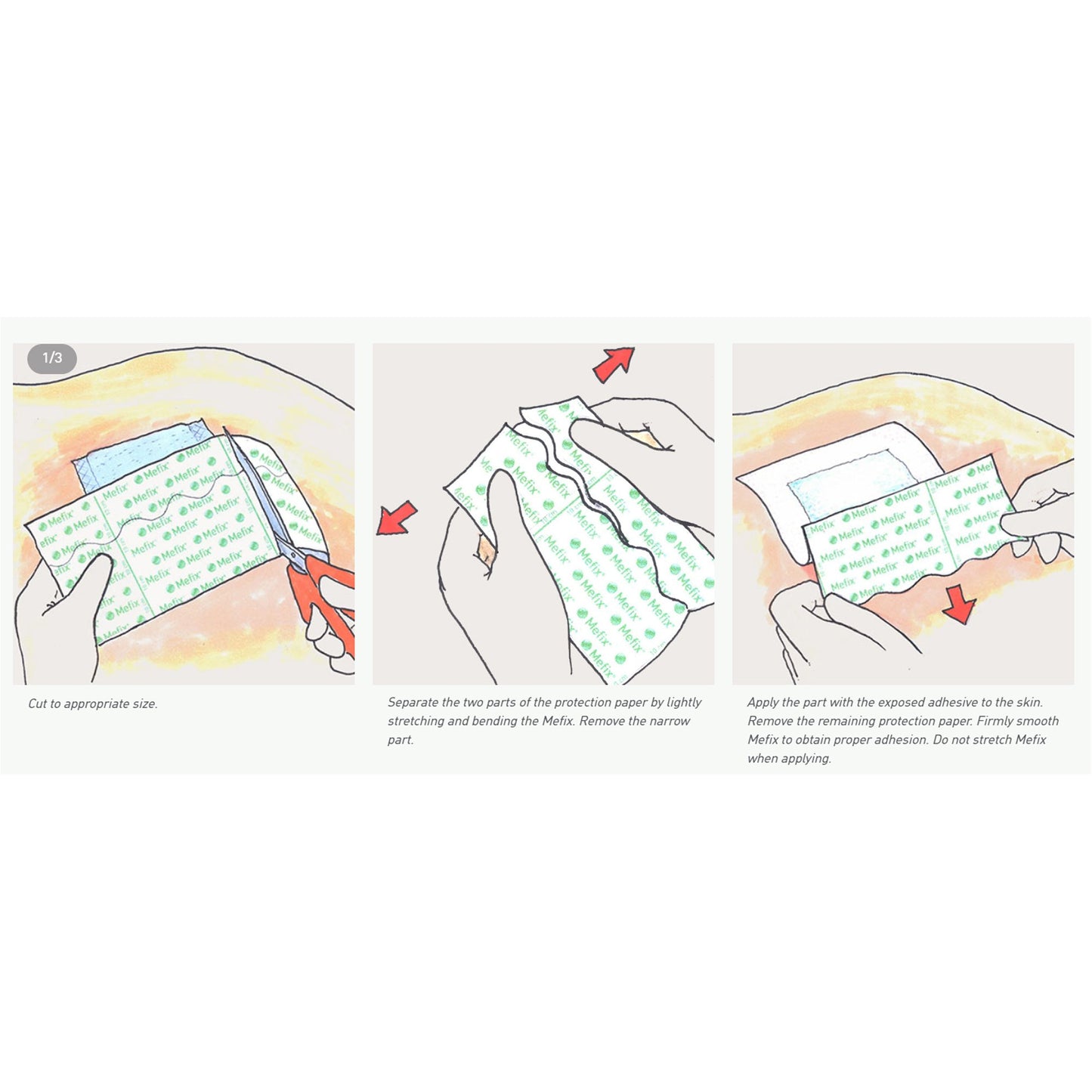 Mefix® Perforated Dressing Retention Tape with Liner White 2 Inch X 11 Yard Nonwoven Spunlace Polyester NonSterile (712220_CS)