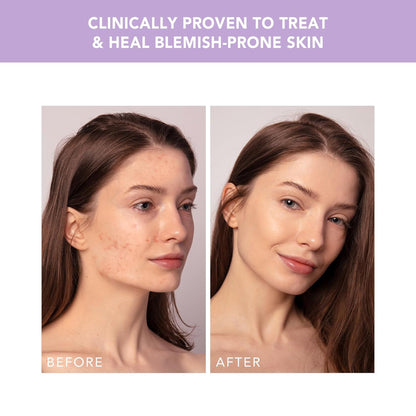 ESPADA™ 2 plus Acne Treatment ESPADA™ 2 plus (1259141_EA)