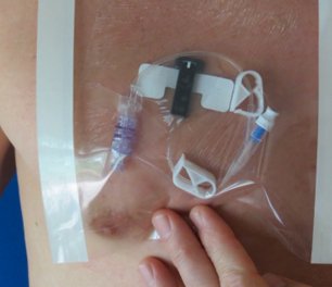 HydroSeal IV Site Barrier Protector 9 X 9 Inch NonSterile (1136592_BX)