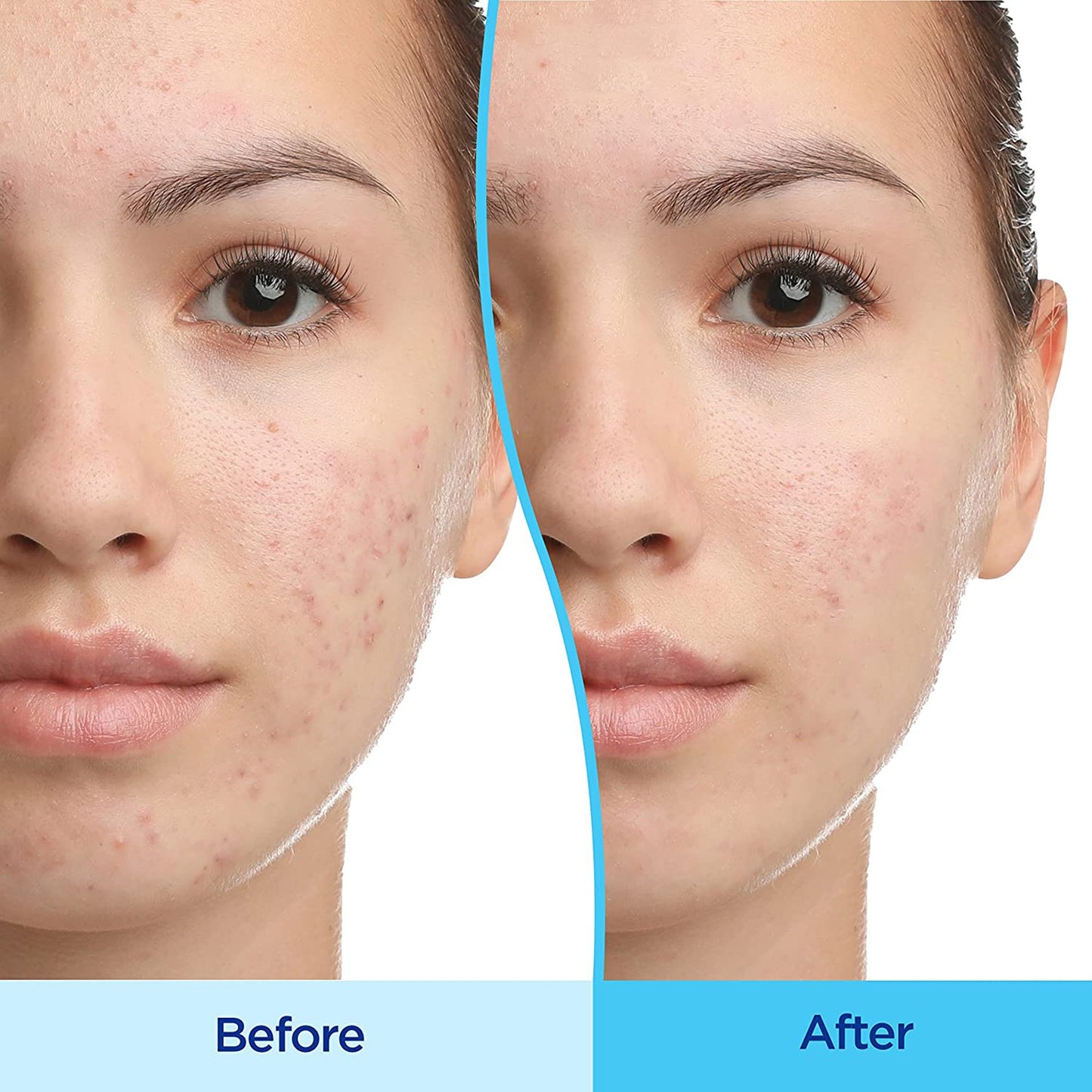 Differin® Gel Acne Treatment 15 Gram Gel (1135869_EA)