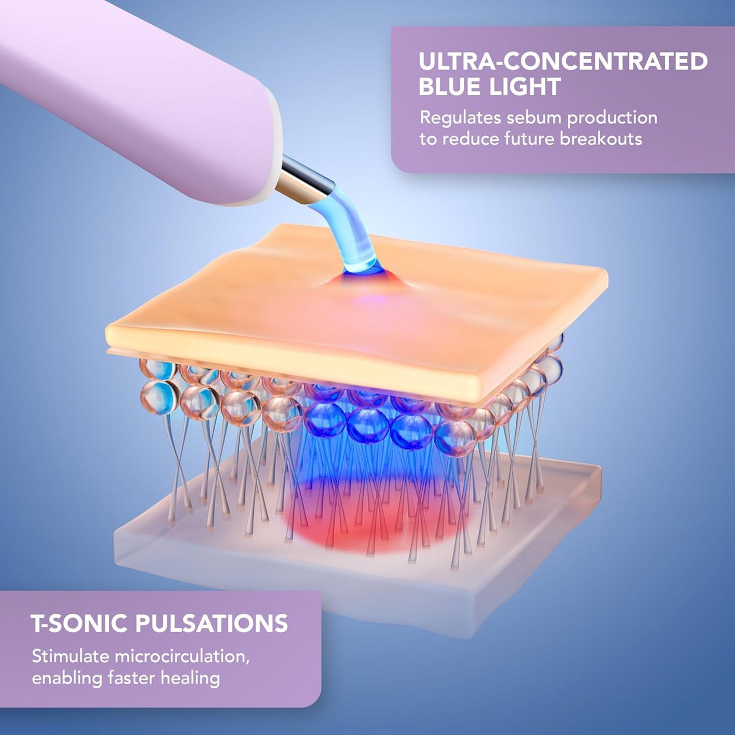 ESPADA™ 2 plus Acne Treatment ESPADA™ 2 plus (1259141_EA)