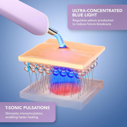 ESPADA™ 2 plus Acne Treatment ESPADA™ 2 plus (1259141_EA)
