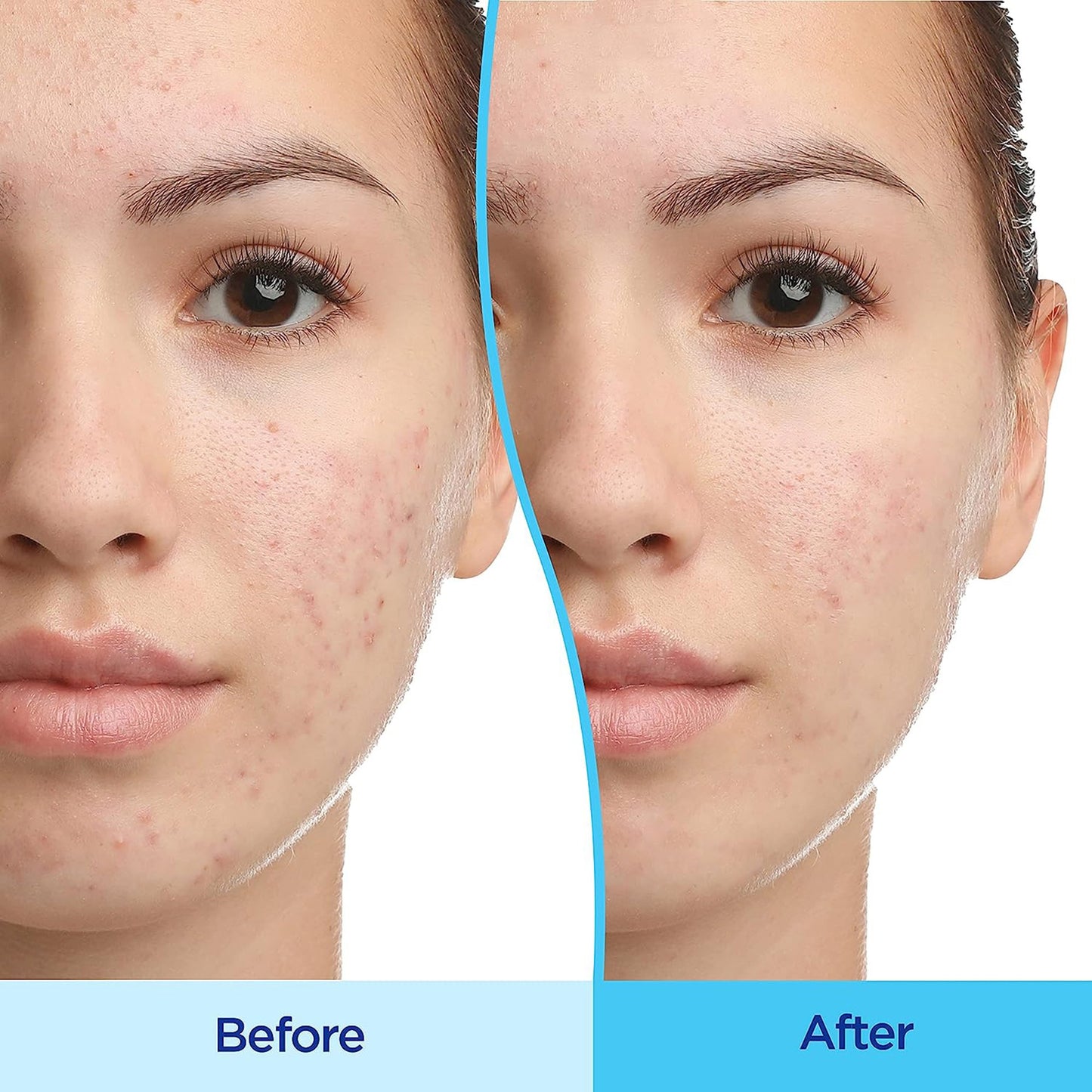 Differin® Acne Treatment 45 Gram Gel (1230047_EA)