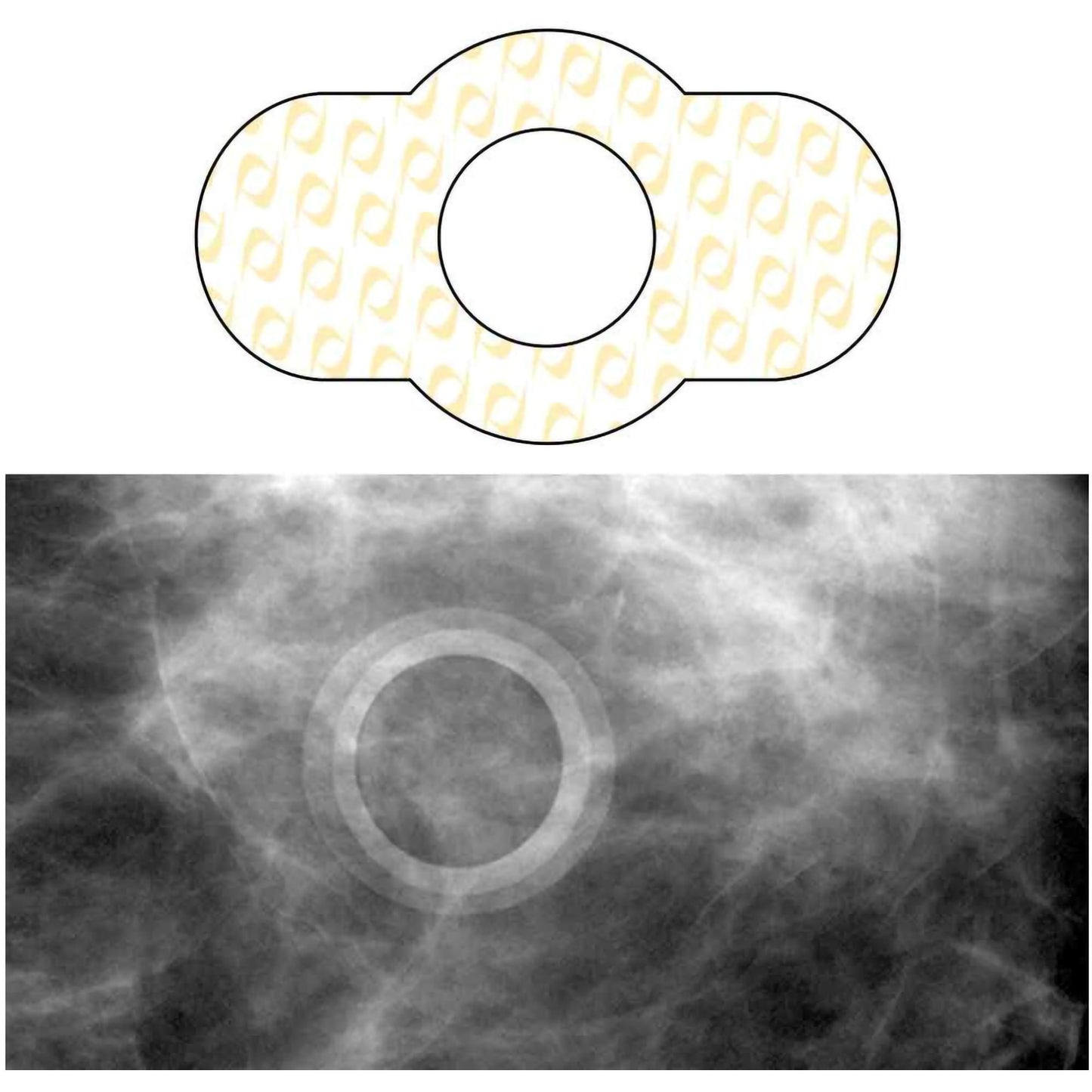 Spee-D-Ring™ Radiology Skin Marker Spee-D-Ring™ (880906_BX)